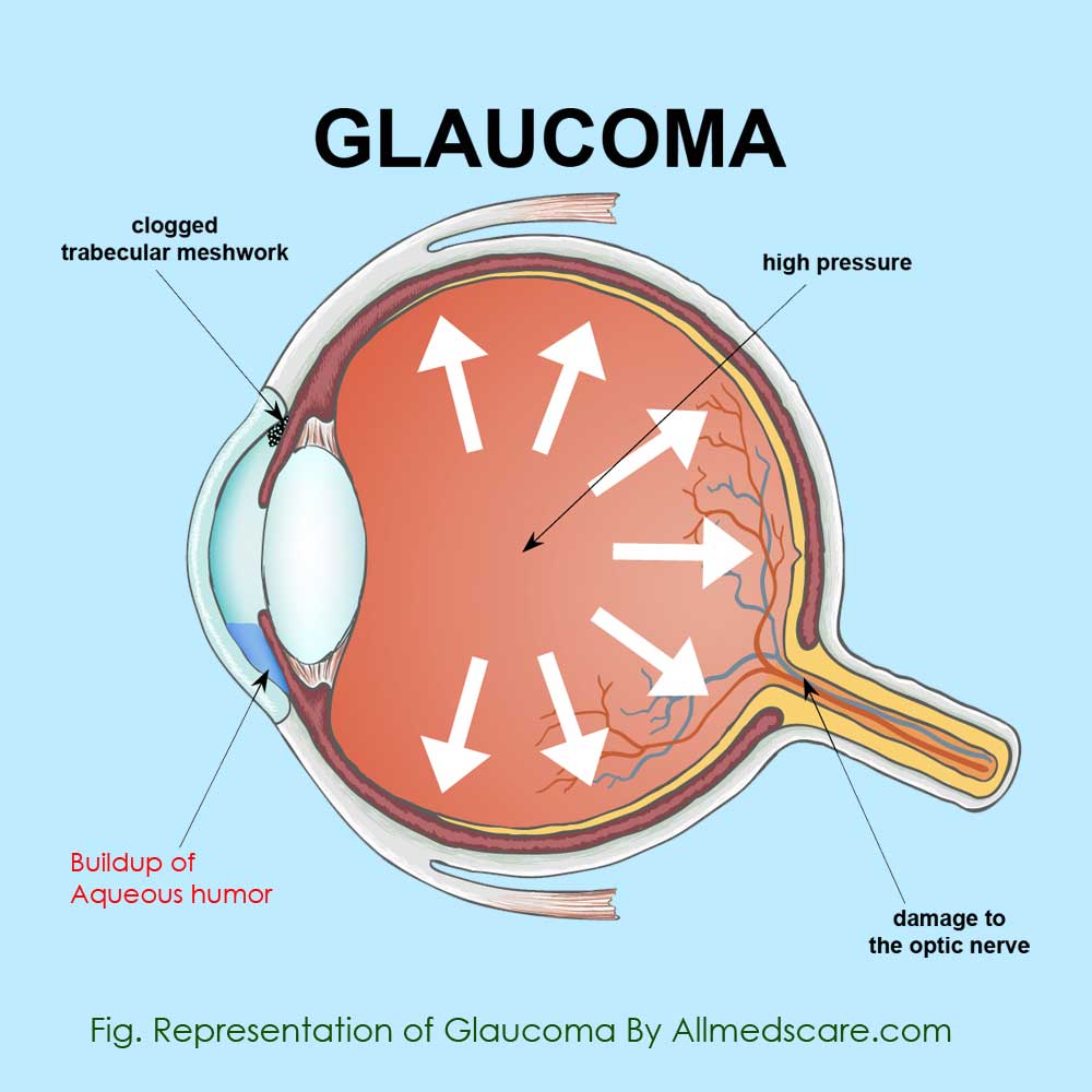 Glaucoma Representation- Allmedscare.com