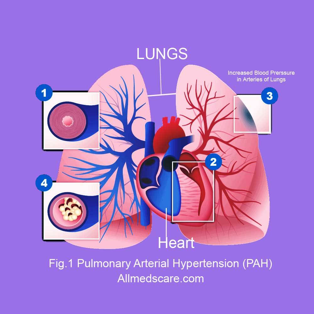 Pulmonary Arterial Hypertension PAH Allmedscare.com
