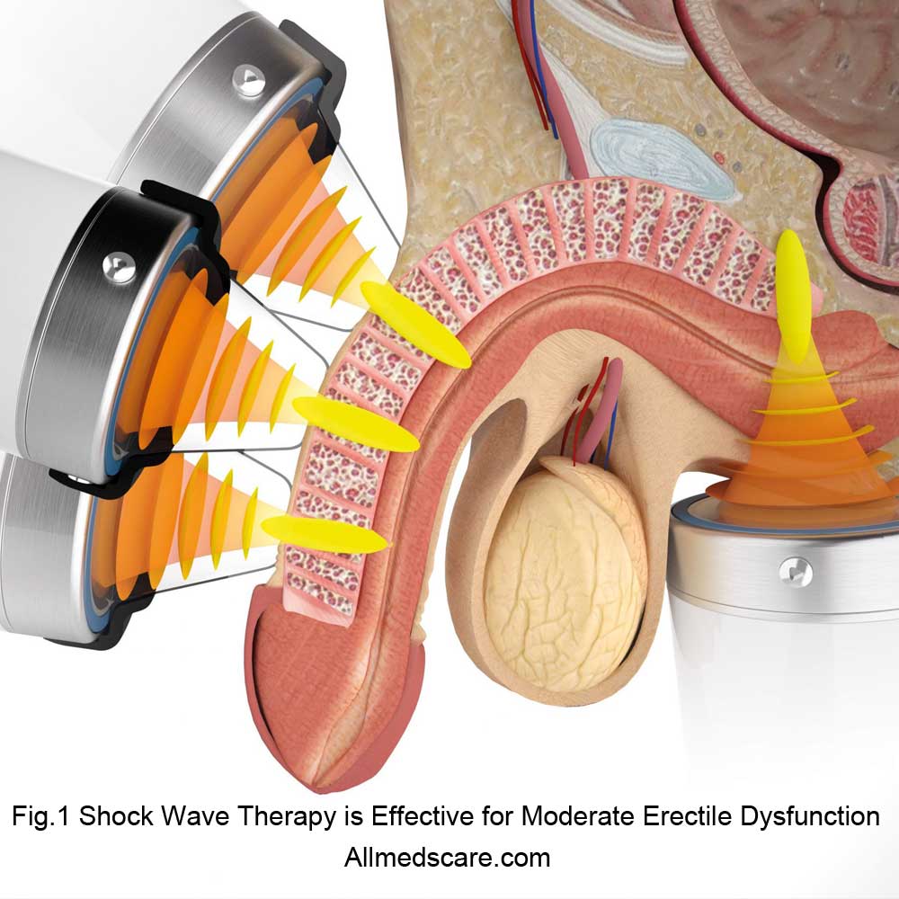 Shock Wave Therapy Erectile Dysfunction- Allmedscare.com