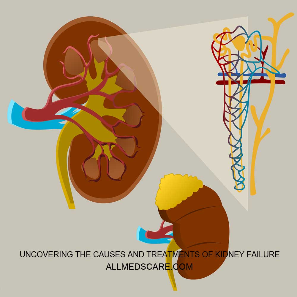 Causes and Treatments of Kidney Failure Allmedscare.com