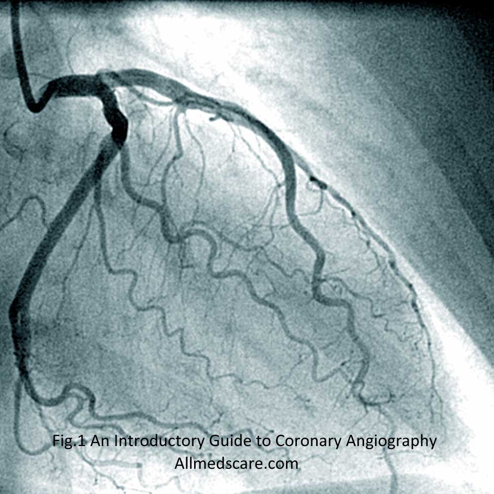 An Introductory Guide to Coronary Angiography -Allmedscare