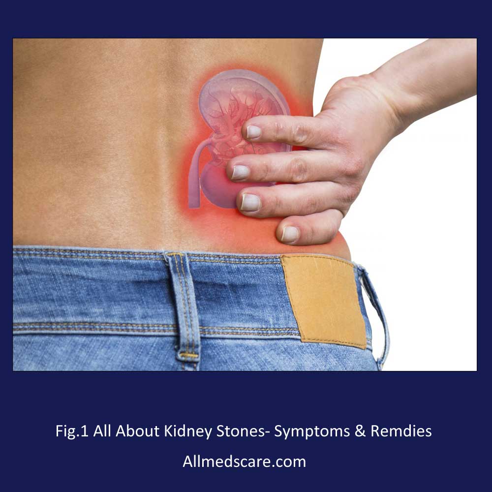 Kidney Stones Symptoms Remedies Allmedscare.com