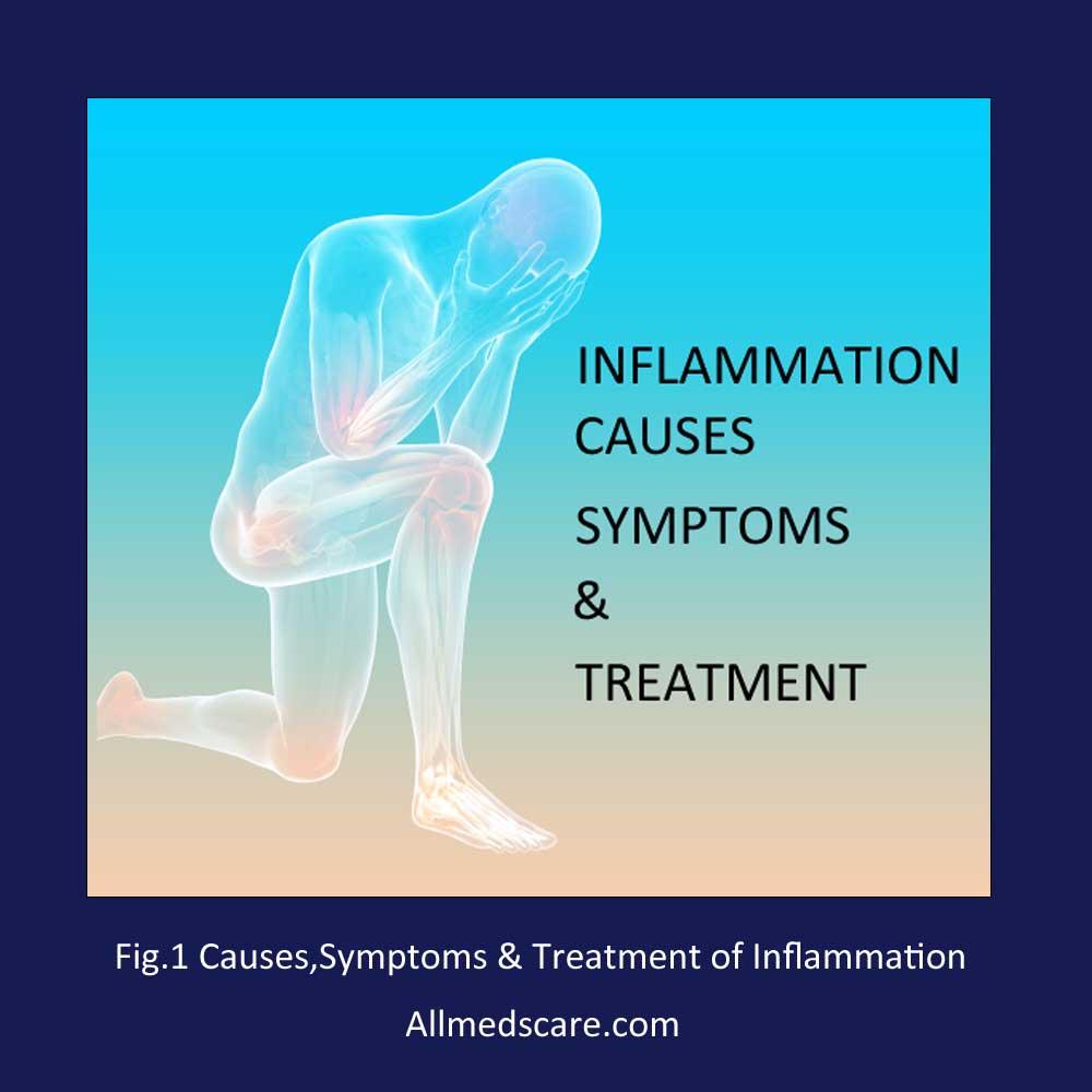 Causes symptoms treatments inflammation Allmedscare.com