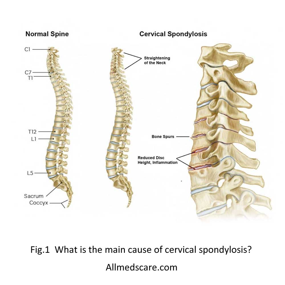 Cervical Spondylosis Causes & Treatments