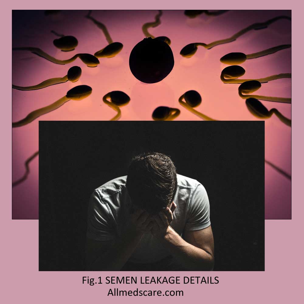 Semen Leakage Information Details Allmedscare.com