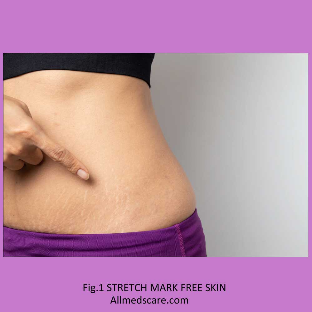 Stretch Mark Free Skin Allmedscare.com