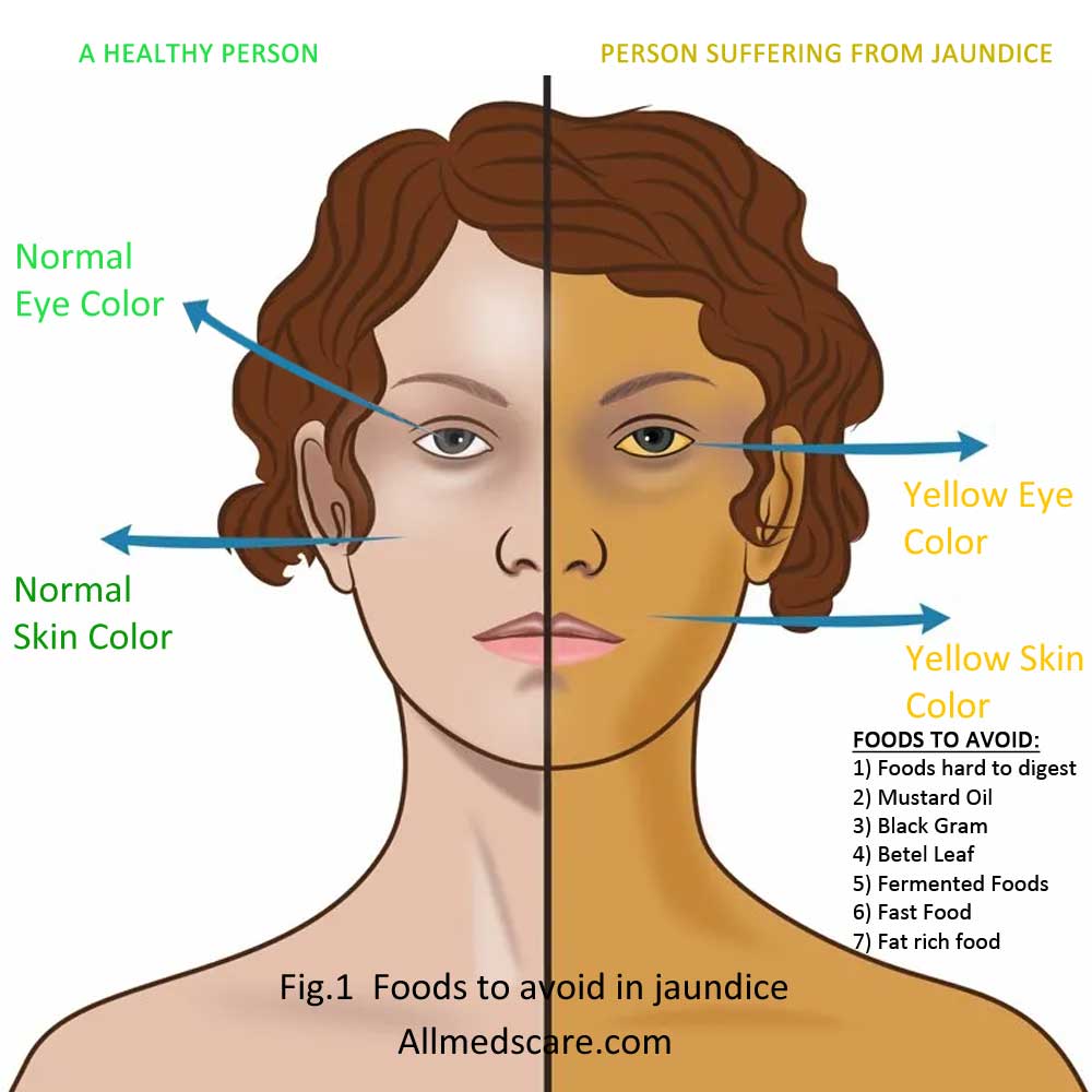 Foods to avoid in jaundice-Allmedscare