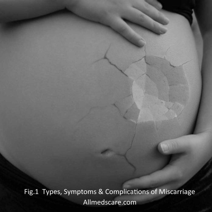 Miscarriage Types, Causes & Prevention Techniques