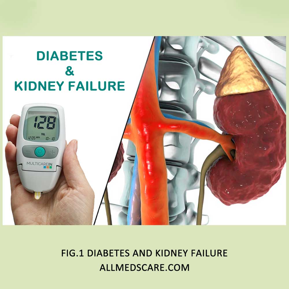 Diabetes And Kidney Failure