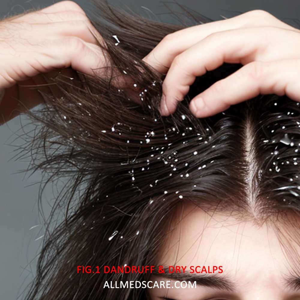 Dry Scalp and Dandruff