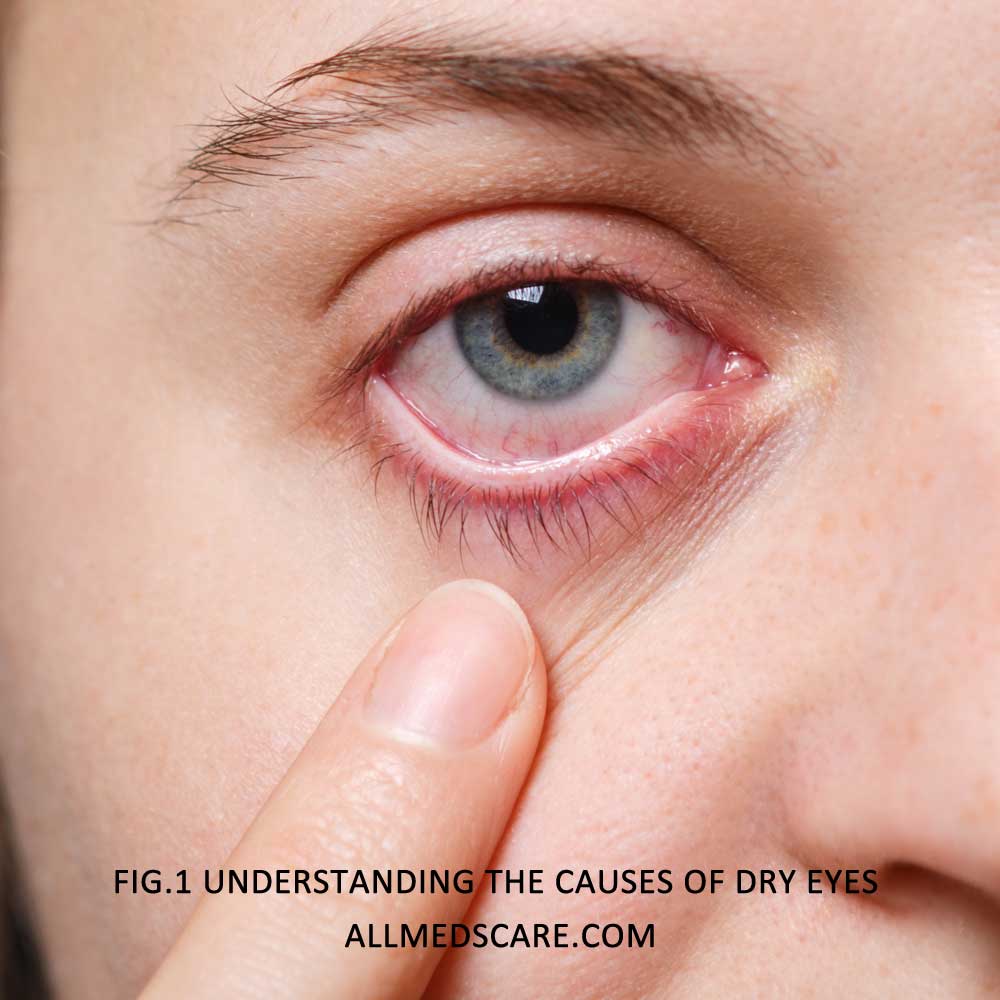 Understanding the Causes of Dry Eyes