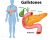 Gallbladder stones