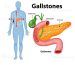 Gallbladder stones