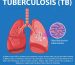 Tuberculosis Full Authentic Information
