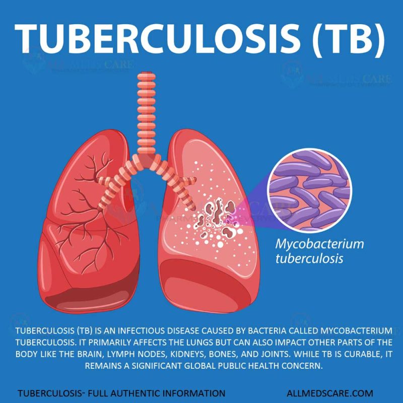 Tuberculosis Full Authentic Information