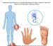 Peripheral Neuropathy