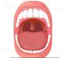 Tonsil Stones 101