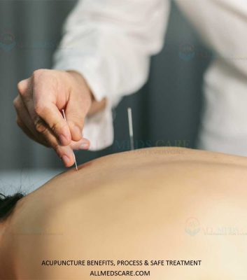 Acupuncture Benefits Process Safe Treatment