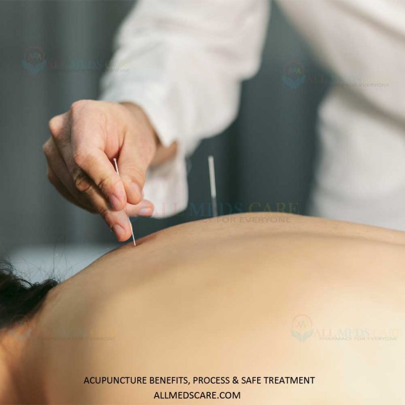Acupuncture Benefits Process Safe Treatment