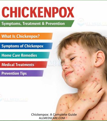 Chickenpox A Complete Guide
