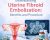Uterine Fibroid Embolization