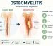 Osteomyelitis Risk Factors Symptoms Recovery
